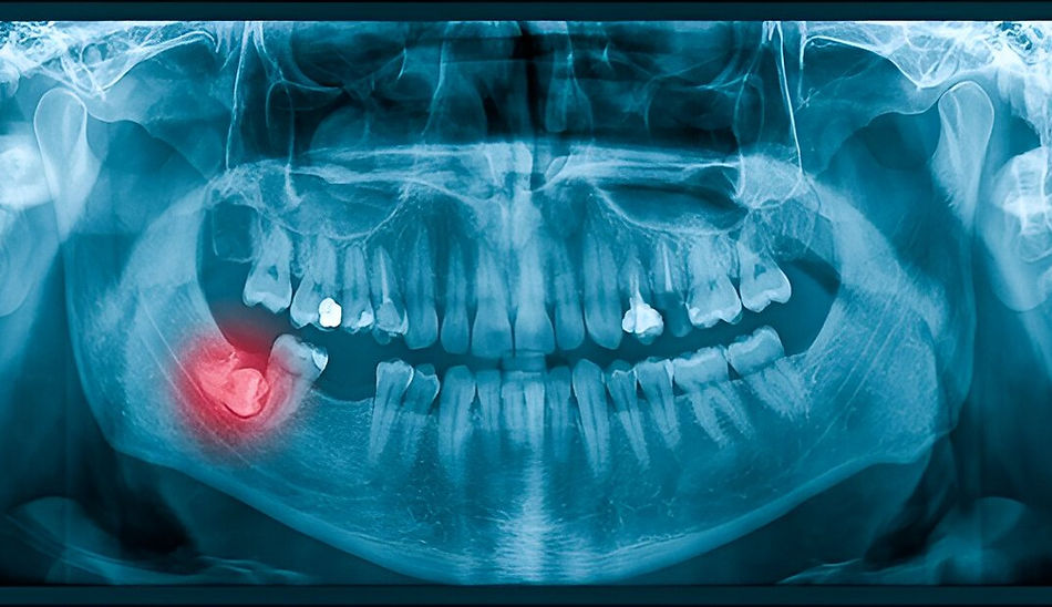 Dental panoramic X-ray showing impacted lower wisdom tooth highlighted in red