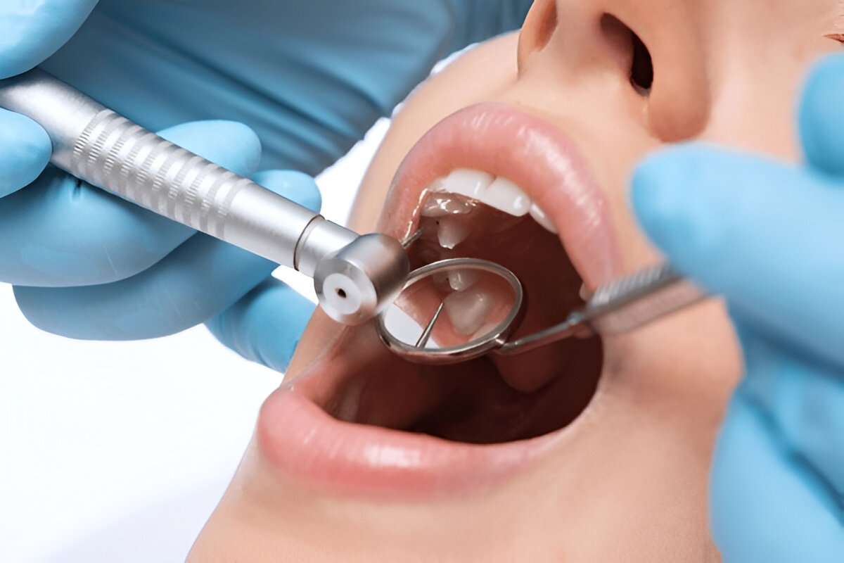 Close-up of dentist performing tooth filling procedure in Sherwood Park