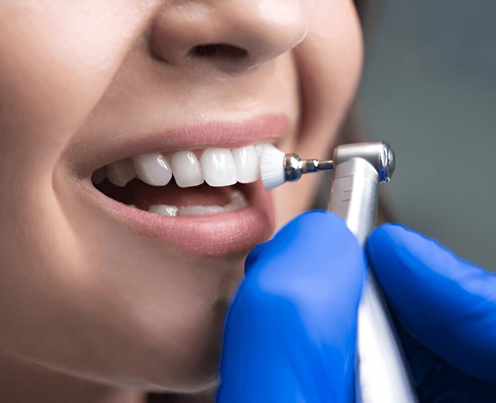Dental Veneers Sherwood Park